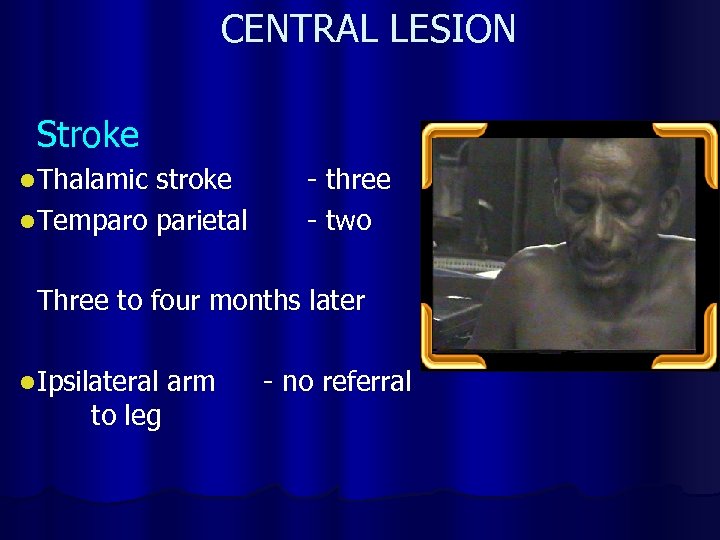 CENTRAL LESION Stroke l Thalamic stroke l Temparo parietal - three - two Three