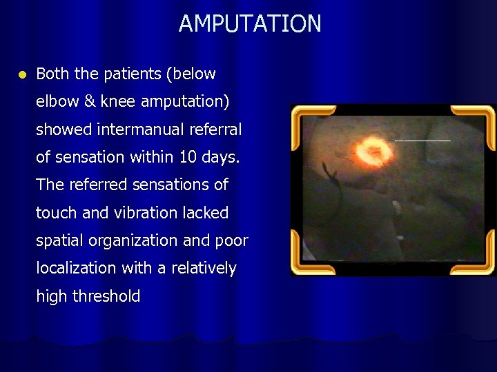 AMPUTATION l Both the patients (below elbow & knee amputation) showed intermanual referral of