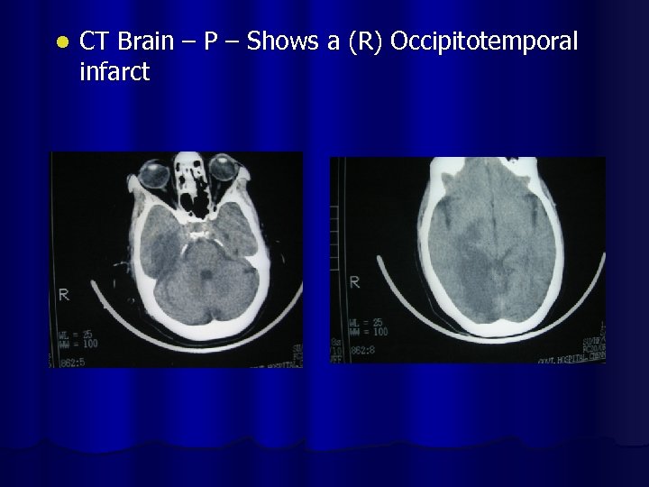l CT Brain – P – Shows a (R) Occipitotemporal infarct 