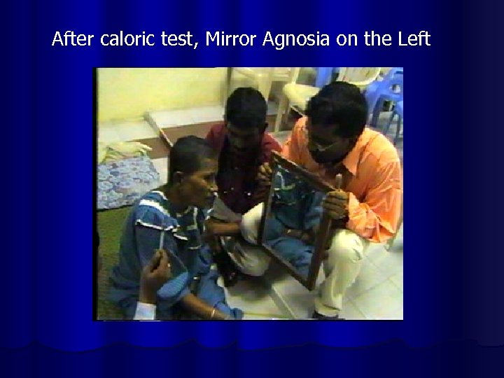 After caloric test, Mirror Agnosia on the Left 