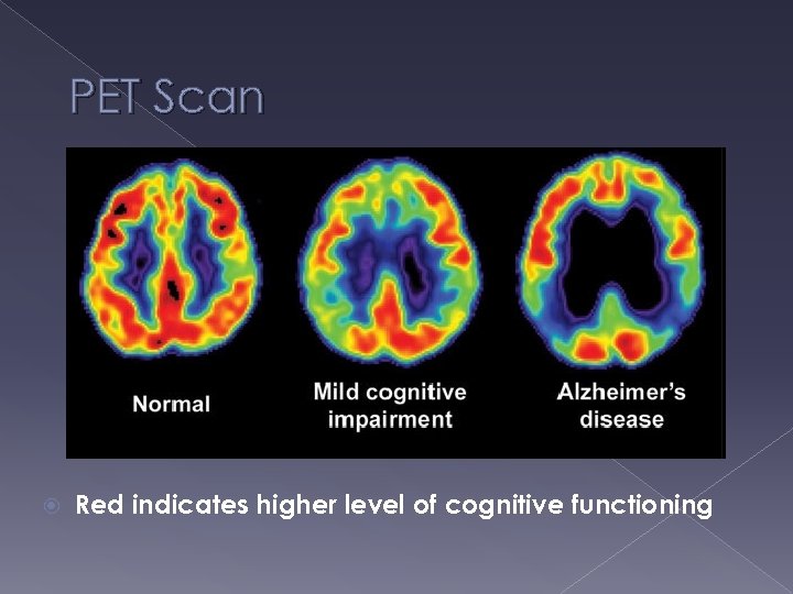 PET Scan Red indicates higher level of cognitive functioning 