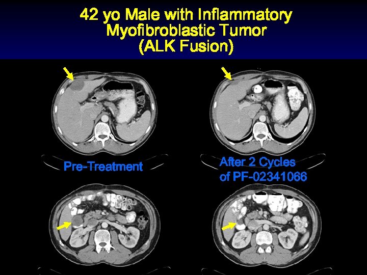 42 yo Male with Inflammatory Myofibroblastic Tumor (ALK Fusion) Pre-Treatment After 2 Cycles of