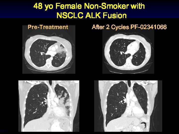 48 yo Female Non-Smoker with NSCLC ALK Fusion Pre-Treatment After 2 Cycles PF-02341066 