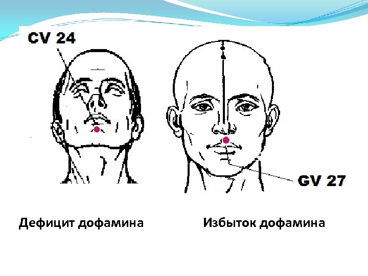 Дефицит дофамина Избыток дофамина 