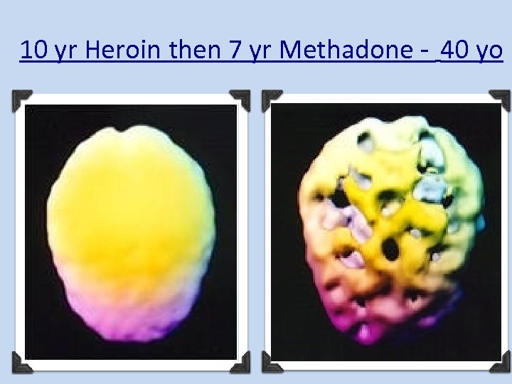 10 yr Heroin then 7 yr Methadone - 40 yo Copyright 2011 - Lighthouse