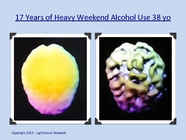 17 Years of Heavy Weekend Alcohol Use 38 yo Copyright 2013 - Lighthouse Network