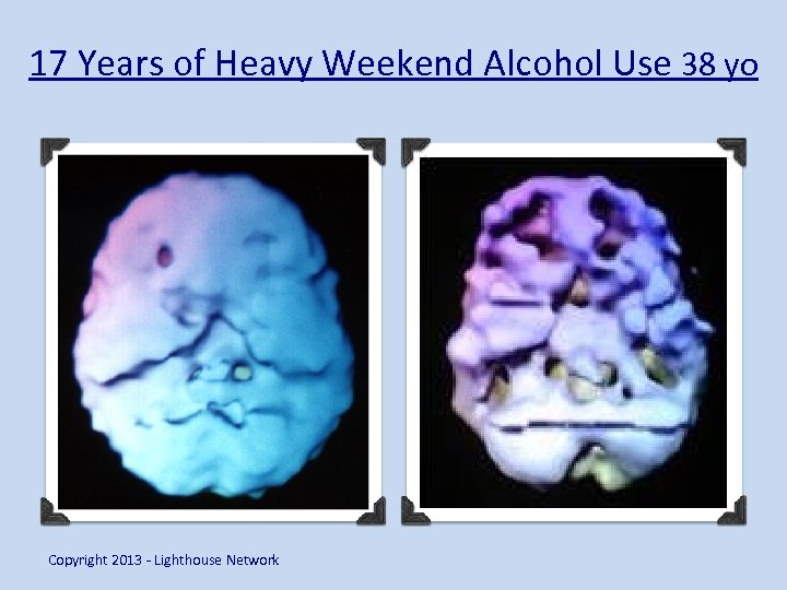 17 Years of Heavy Weekend Alcohol Use 38 yo Copyright 2013 - Lighthouse Network