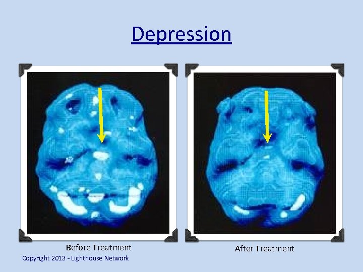 Depression Before Treatment Copyright 2013 - Lighthouse Network After Treatment 