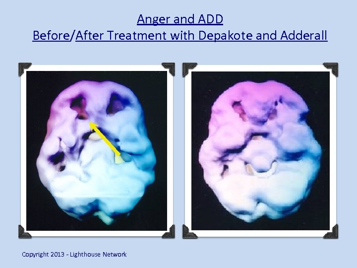 Anger and ADD Before/After Treatment with Depakote and Adderall Copyright 2013 - Lighthouse Network