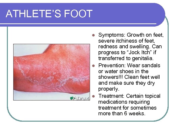 ATHLETE’S FOOT Symptoms: Growth on feet, severe itchiness of feet, redness and swelling. Can