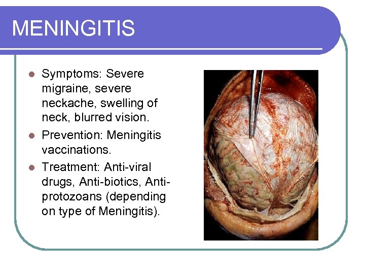 MENINGITIS Symptoms: Severe migraine, severe neckache, swelling of neck, blurred vision. l Prevention: Meningitis
