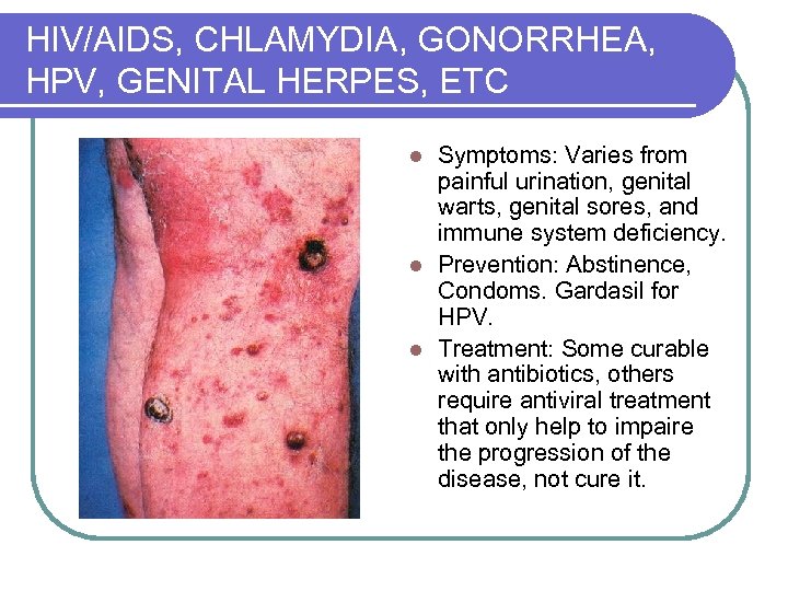 HIV/AIDS, CHLAMYDIA, GONORRHEA, HPV, GENITAL HERPES, ETC Symptoms: Varies from painful urination, genital warts,