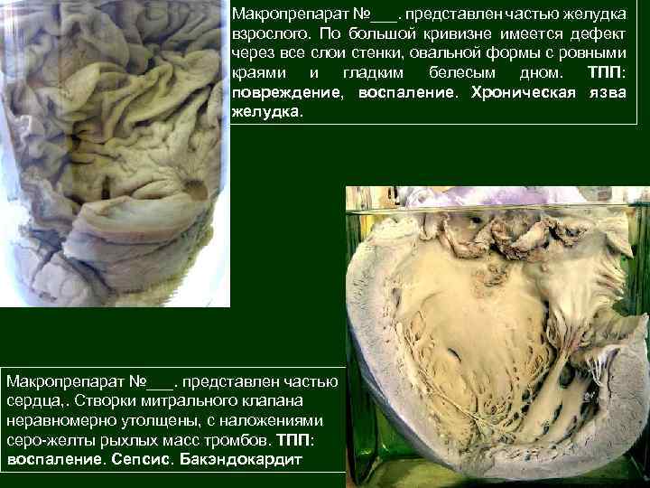 Макропрепарат №___. представлен частью желудка взрослого. По большой кривизне имеется дефект через все слои