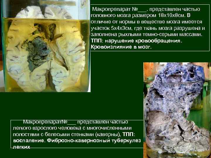 Макропрепарат №___. представлен частью головного мозга размером 18 х10 х8 см. В отличие от