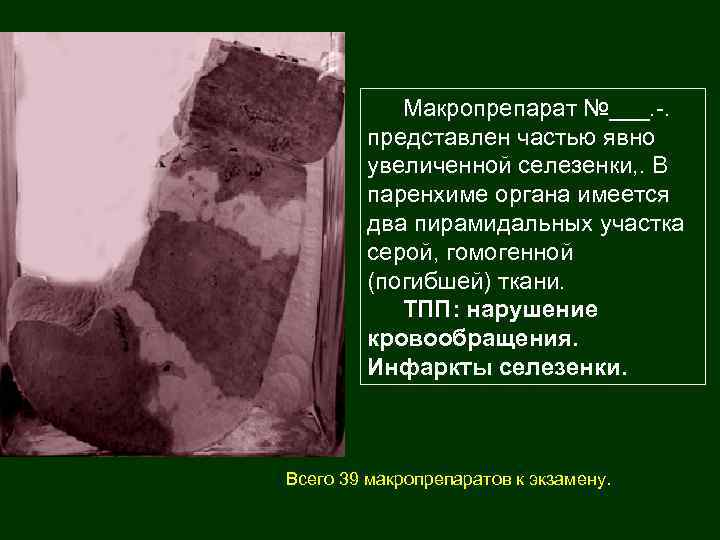 Макропрепарат №___. -. представлен частью явно увеличенной селезенки, . В паренхиме органа имеется два