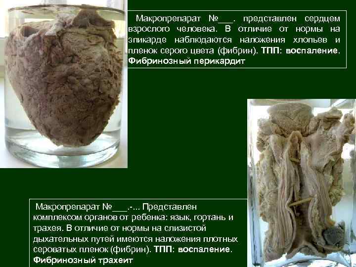 Макропрепарат №___. представлен сердцем взрослого человека. В отличие от нормы на эпикарде наблюдаются наложения
