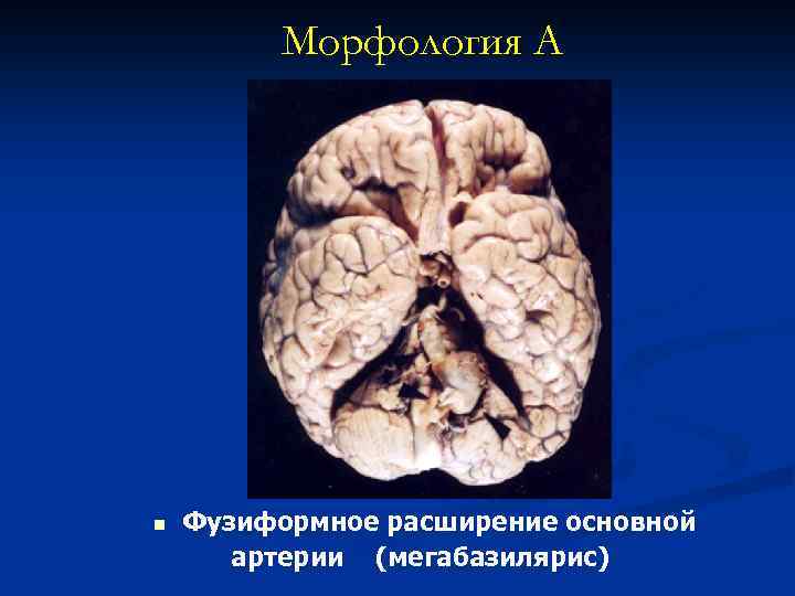 Морфология А n Фузиформное расширение основной артерии (мегабазилярис) 
