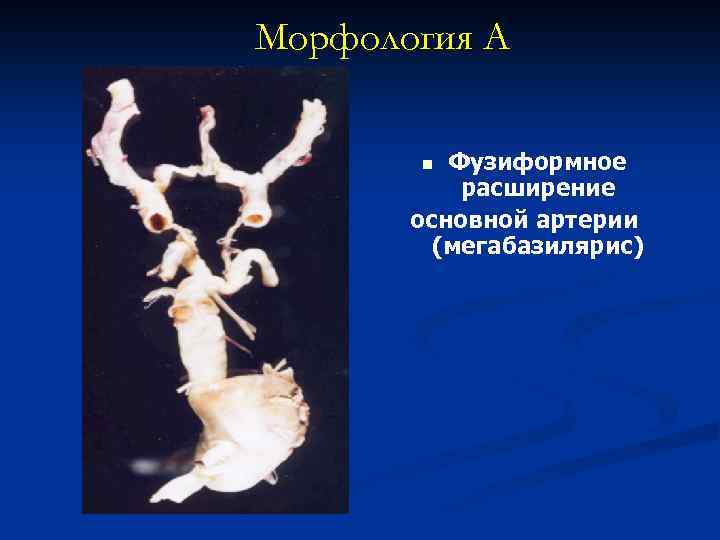 Морфология А Фузиформное расширение основной артерии (мегабазилярис) n 