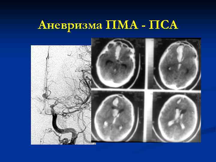 Аневризма ПМА - ПСА 