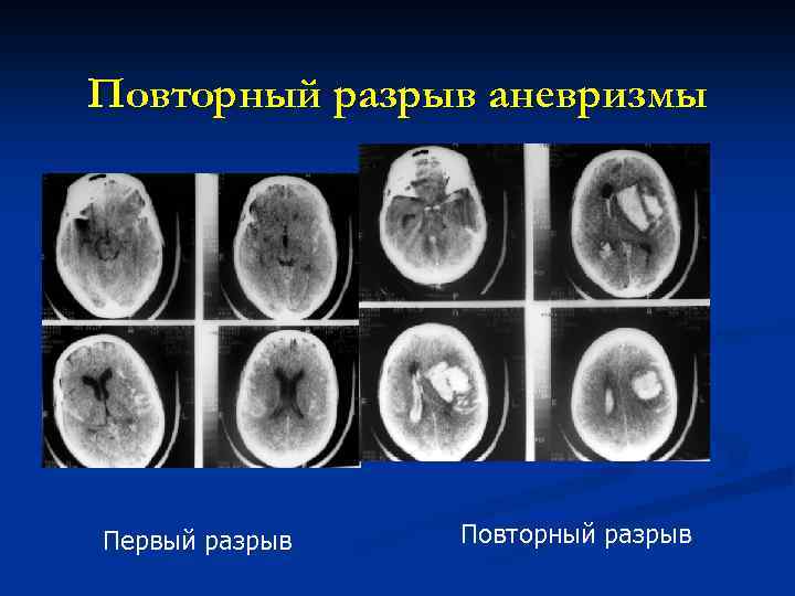 Повторный разрыв аневризмы Первый разрыв Повторный разрыв 
