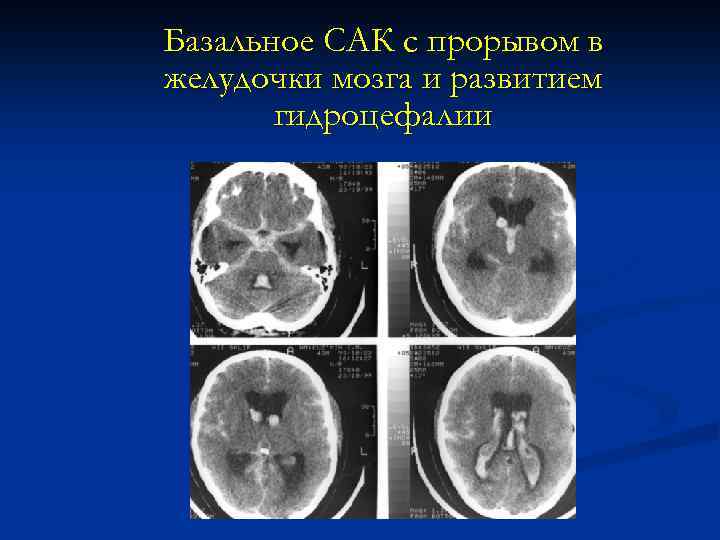 Базальное САК с прорывом в желудочки мозга и развитием гидроцефалии 