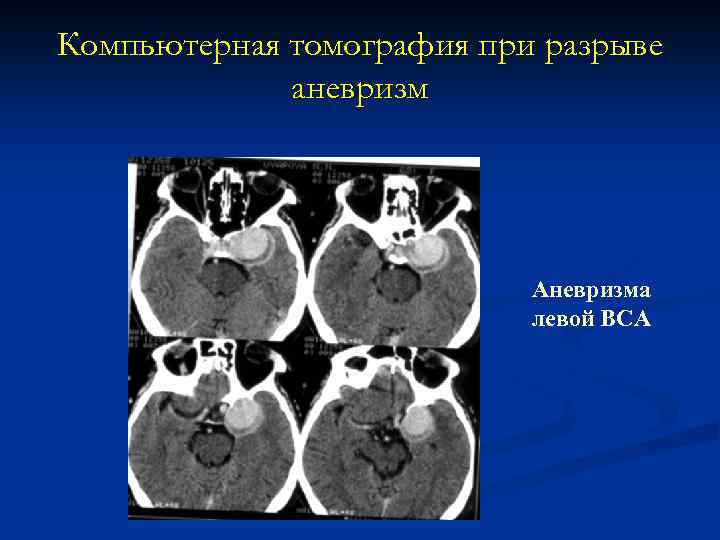 Компьютерная томография при разрыве аневризм Аневризма левой ВСА 