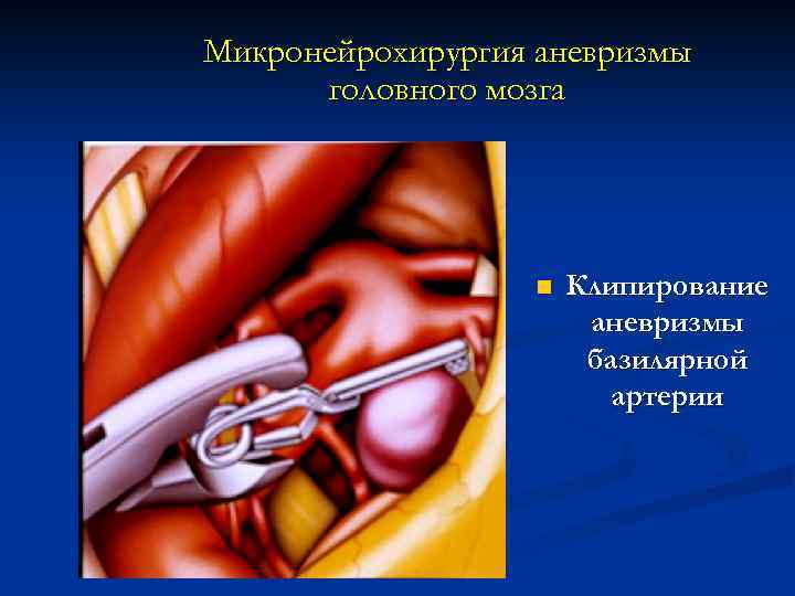 Микронейрохирургия аневризмы головного мозга n Клипирование аневризмы базилярной артерии 