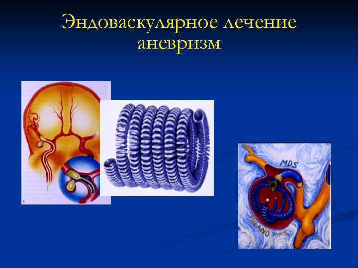 Эндоваскулярное лечение аневризм 