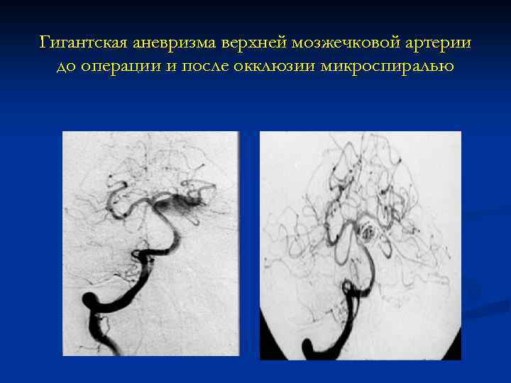 Гигантская аневризма верхней мозжечковой артерии до операции и после окклюзии микроспиралью 