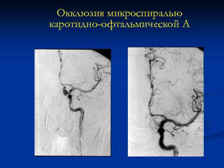 Окклюзия микроспиралью каротидно-офтальмической А 