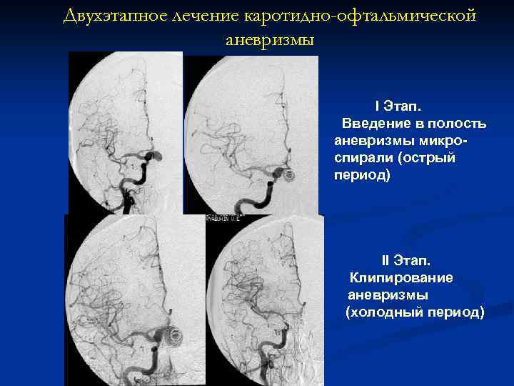 Двухэтапное лечение каротидно-офтальмической аневризмы I Этап. Введение в полость аневризмы микроспирали (острый период) II