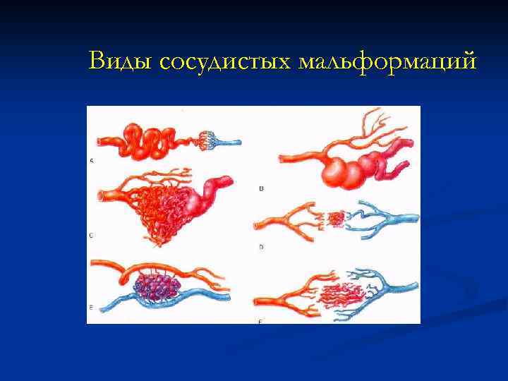 Виды сосудистых мальформаций 