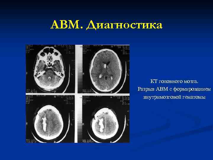 АВМ. Диагностика КТ головного мозга. Разрыв АВМ с формированием внутримозговой гематомы 