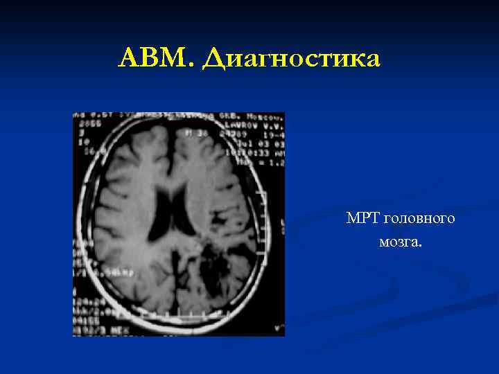 АВМ. Диагностика МРТ головного мозга. 