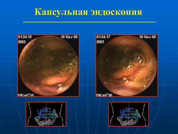 Капсульная эндоскопия 