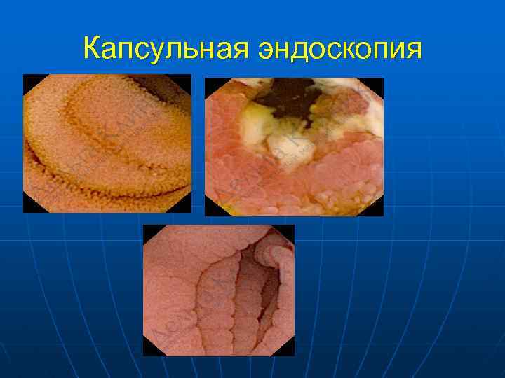 Капсульная эндоскопия 