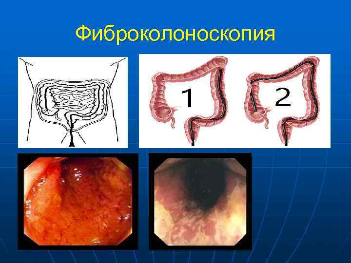 Фиброколоноскопия 