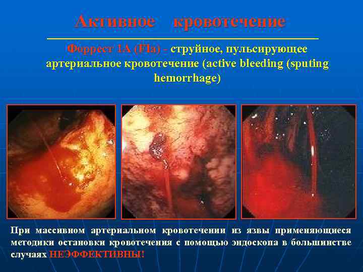 Активное кровотечение Форрест 1 А (FIa) - струйное, пульсирующее артериальное кровотечение (active bleeding (sputing