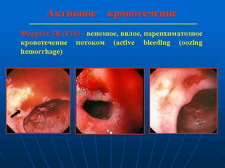 Активное кровотечение Форрест 1 В (F 1 b) - венозное, вялое, паренхиматозное кровотечение потоком