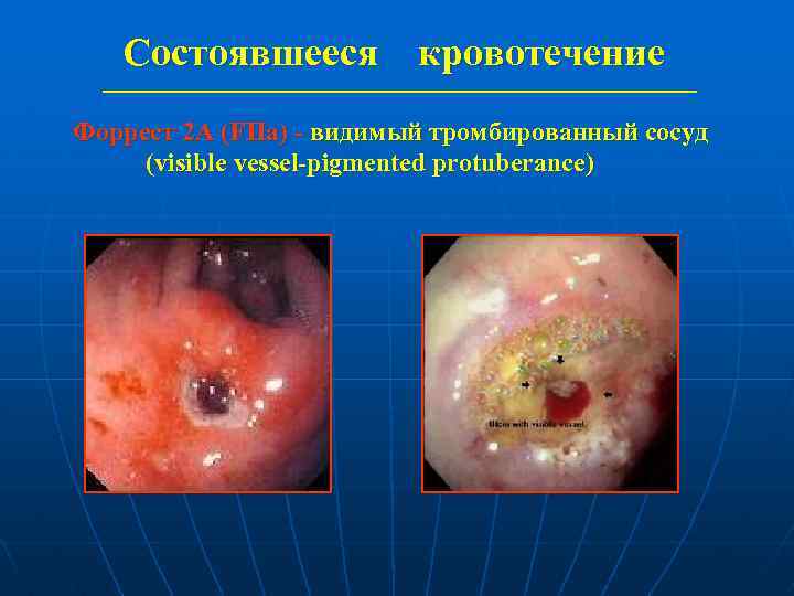 Состоявшееся кровотечение Форрест 2 А (FIIa) - видимый тромбированный сосуд (visible vessel-pigmented protuberance) 