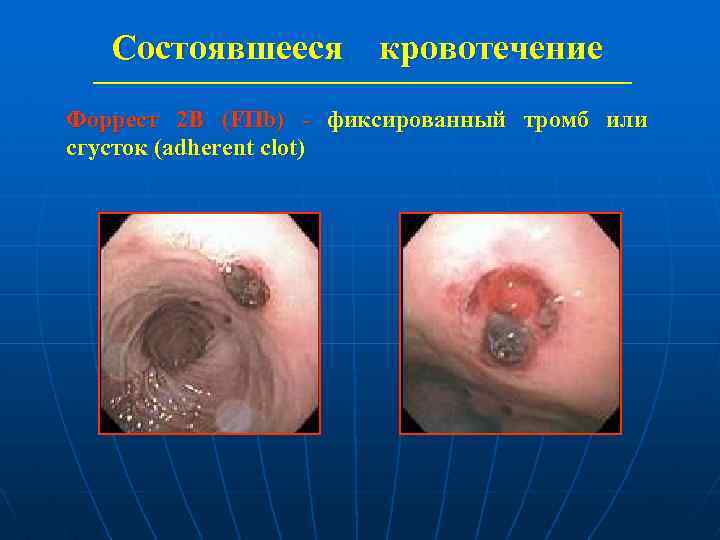 Состоявшееся кровотечение Форрест 2 В (FIIb) - фиксированный тромб или сгусток (adherent clot) 
