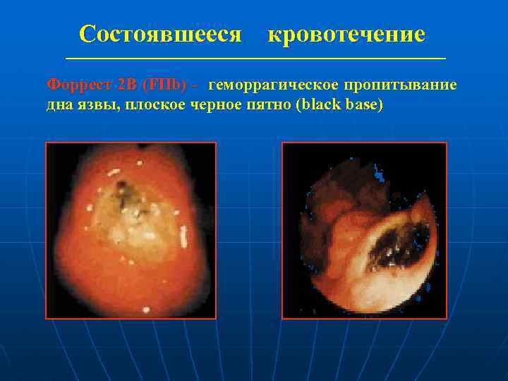 Состоявшееся кровотечение Форрест 2 В (FIIb) - геморрагическое пропитывание дна язвы, плоское черное пятно