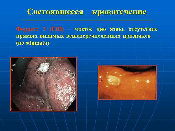 Состоявшееся кровотечение Форрест 3 (FIII) – чистое дно язвы, отсутствие прямых видимых вешеперечисленных признаков