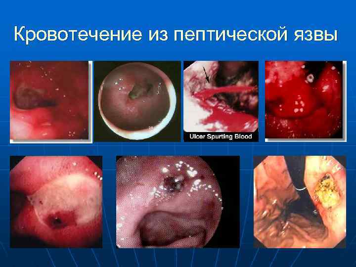 Кровотечение из пептической язвы 