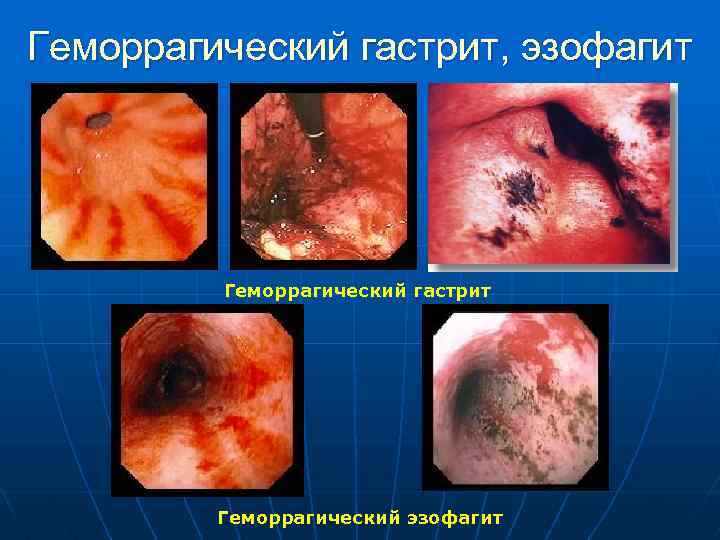 Геморрагический гастрит, эзофагит Геморрагический гастрит Геморрагический эзофагит 