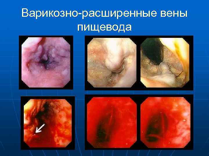 Варикозно-расширенные вены пищевода 