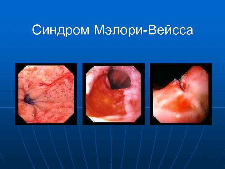 Синдром Мэлори-Вейсса 
