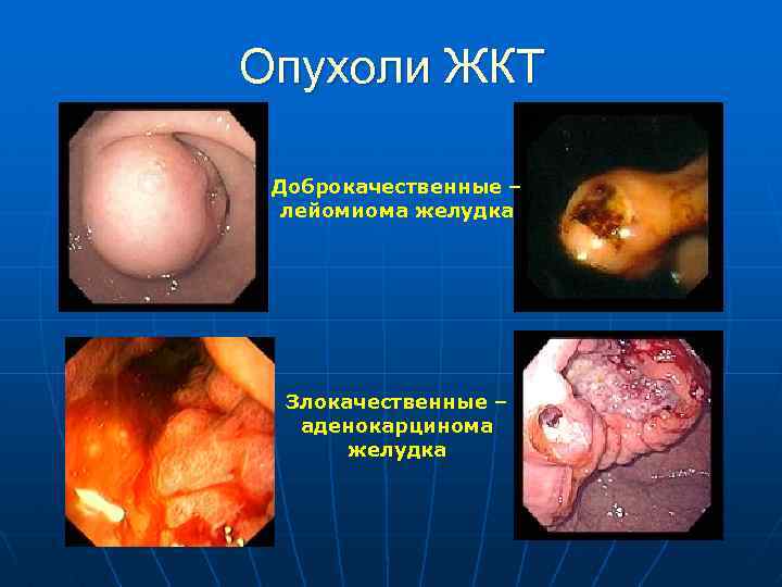 Опухоли ЖКТ Доброкачественные – лейомиома желудка Злокачественные – аденокарцинома желудка 