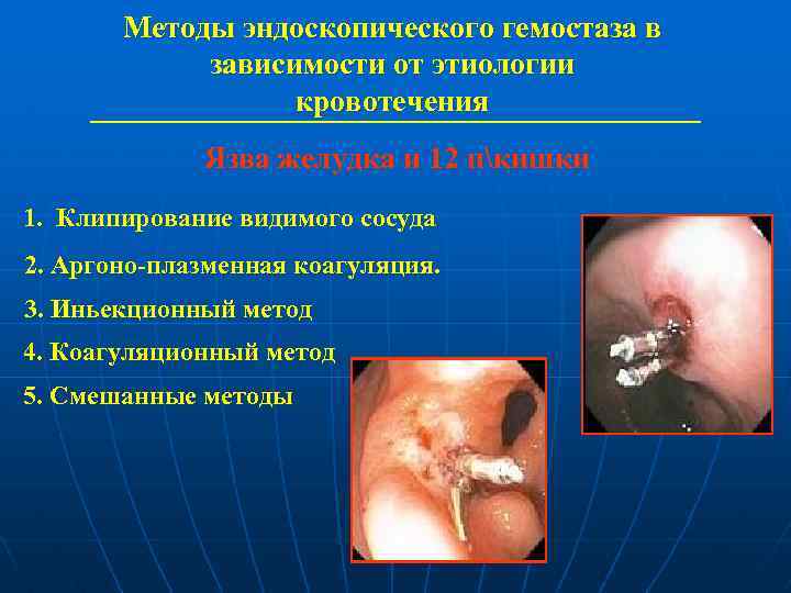 Методы эндоскопического гемостаза в зависимости от этиологии кровотечения Язва желудка и 12 пкишки 1.