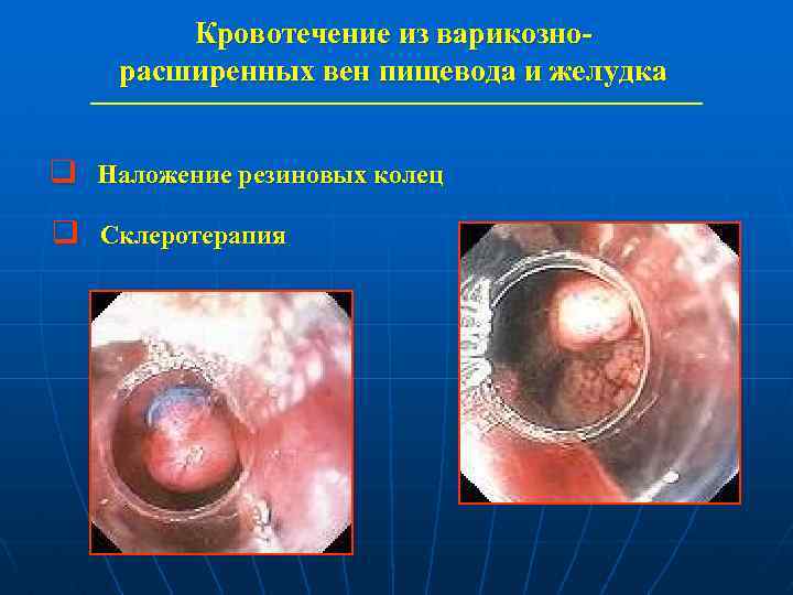 Кровотечение из варикознорасширенных вен пищевода и желудка q Наложение резиновых колец q Склеротерапия 